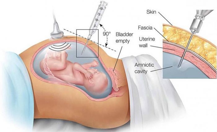 amniocentesis-test-in-pregnancy